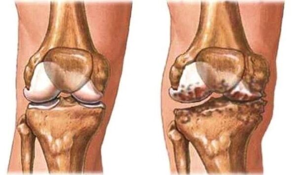 здраво коляно и колянна артроза