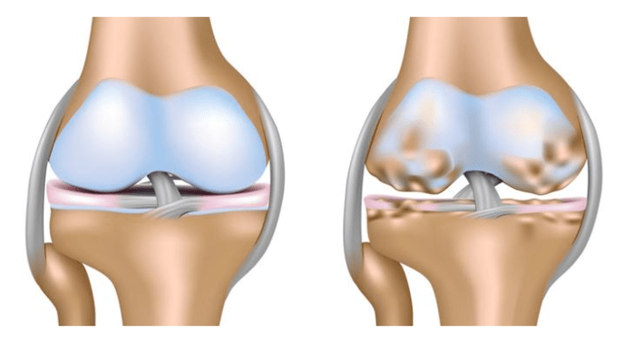 здрав хрущял и увреждане на колянната става с артроза