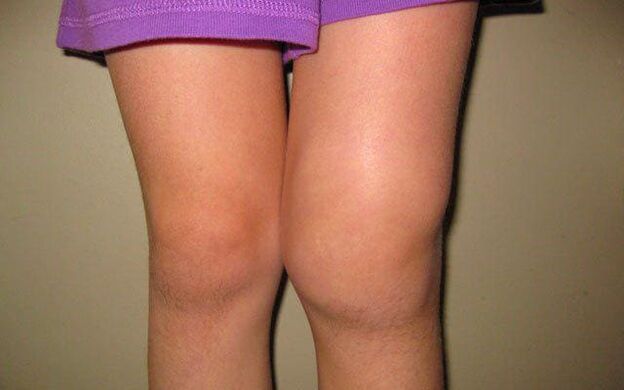 подута колянна става поради остеоартрит