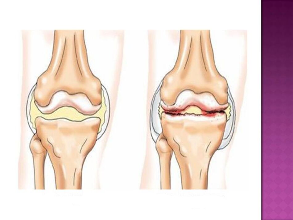 Ставата е нормална (вляво) и засегната от остеоартрит (вдясно)
