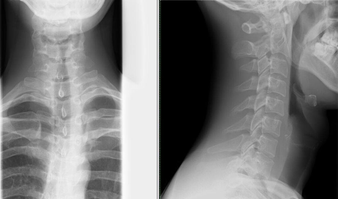 Рентгенографията на гръбначния стълб е прост и ефективен метод за диагностициране на остеохондроза